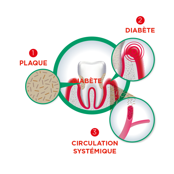Infographic about the link between diabetes and periodontal desease