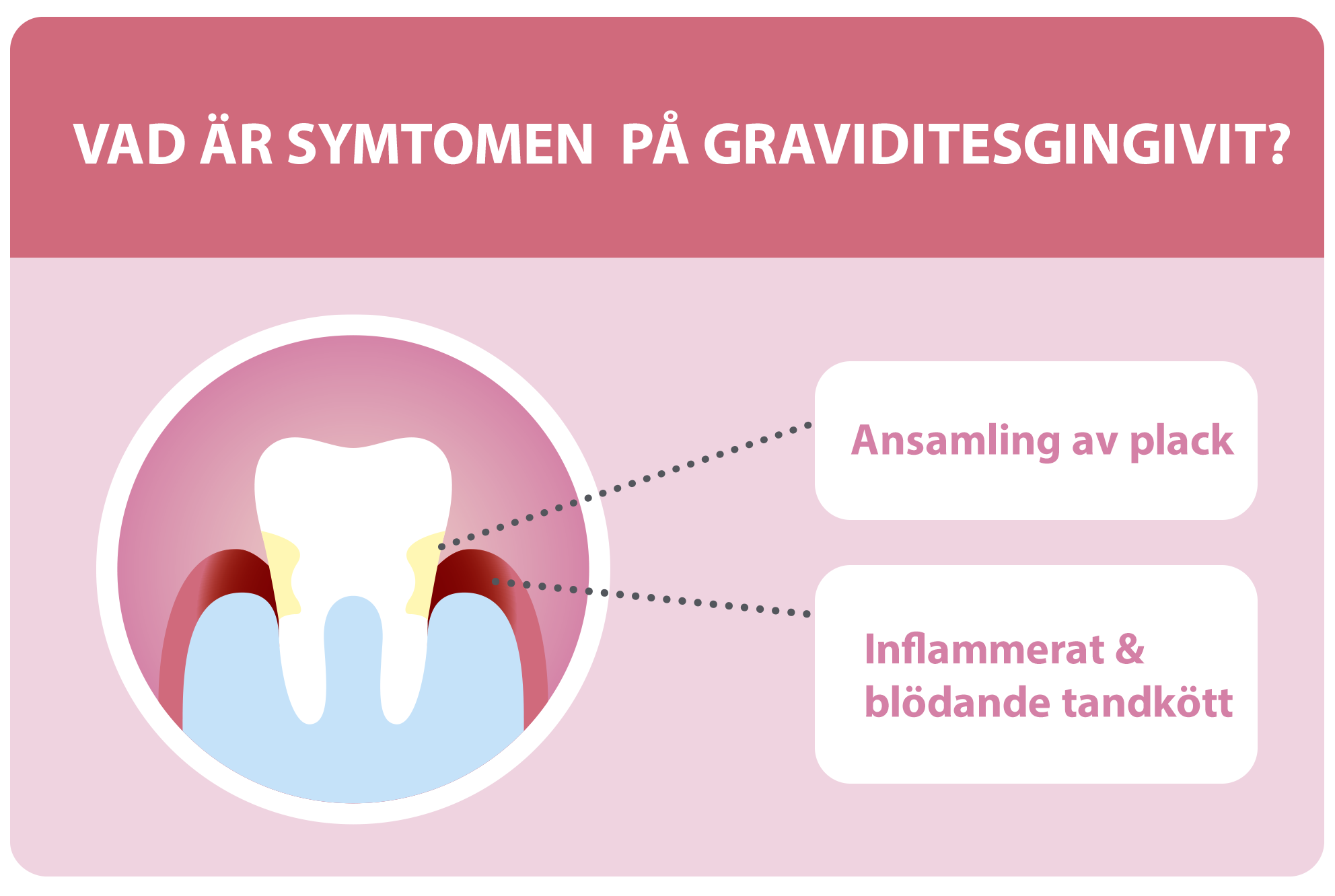 Tand illustrerad med tandplack och graviditetsgingivit