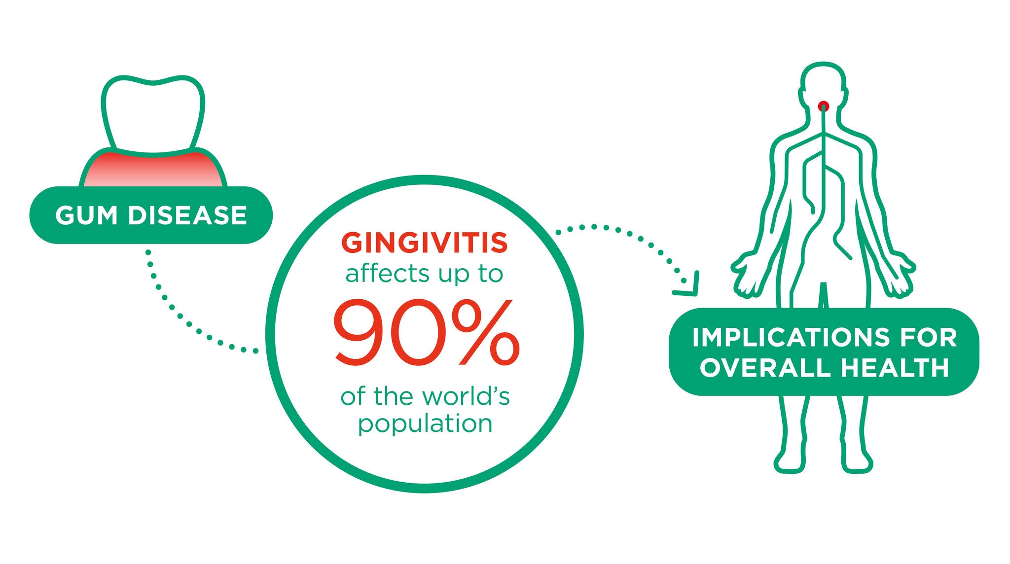 Gingivitis betrifft bis zu 90% der Menschheit