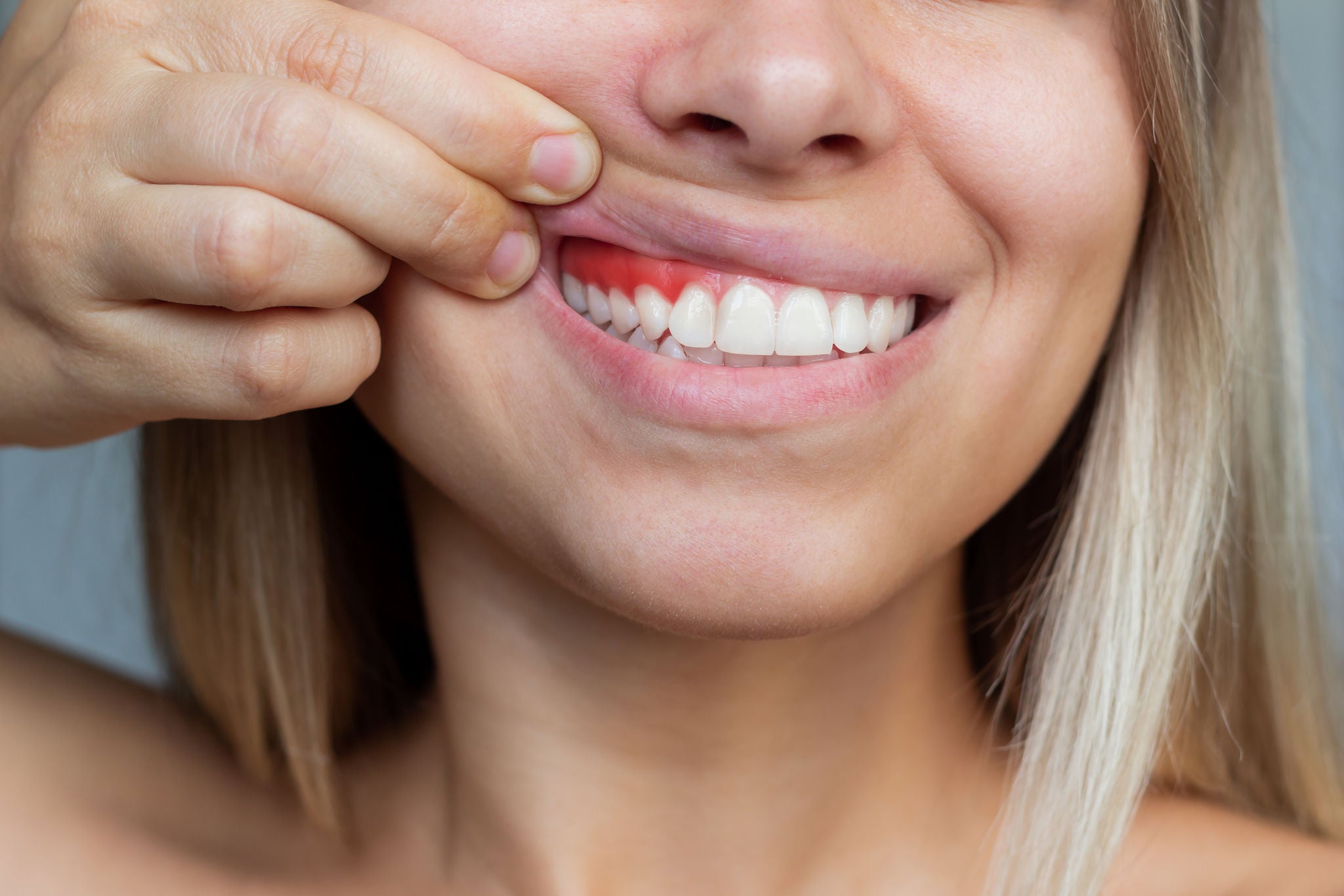 Gum inflammation. Close-up of a young woman showing bleeding gums on a gray background. Dentistry, dental care, Gum inflammation. Close-up of a young woman showing bleeding gum