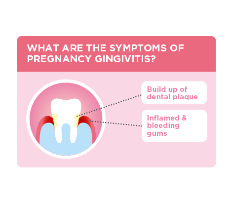 Infographic showing the symptoms of pregnancy gingivitis: build up of dental plaque and inflamed and bleeding gums