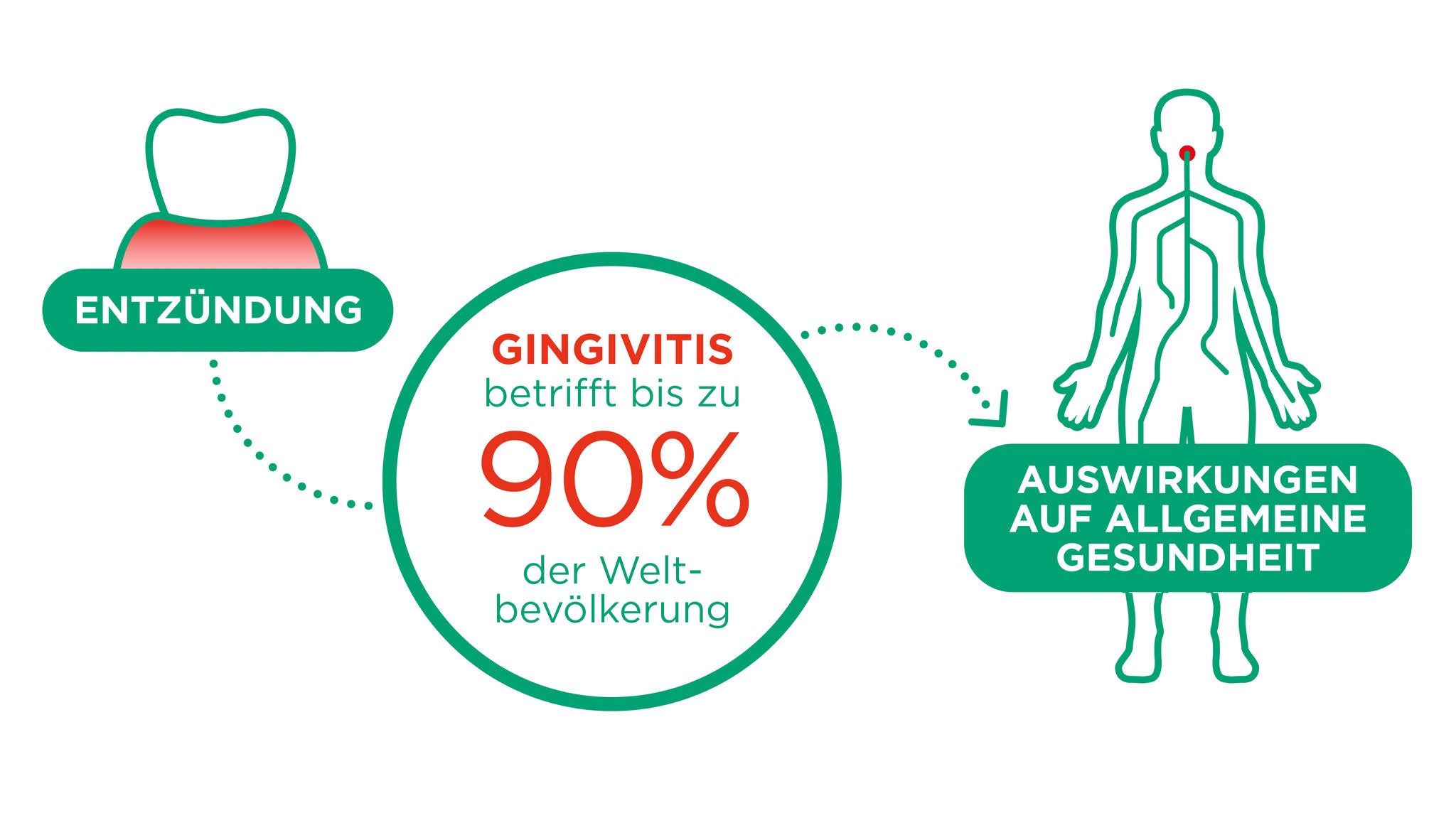 Gingivitis betrifft bis zu 90% der Menschheit