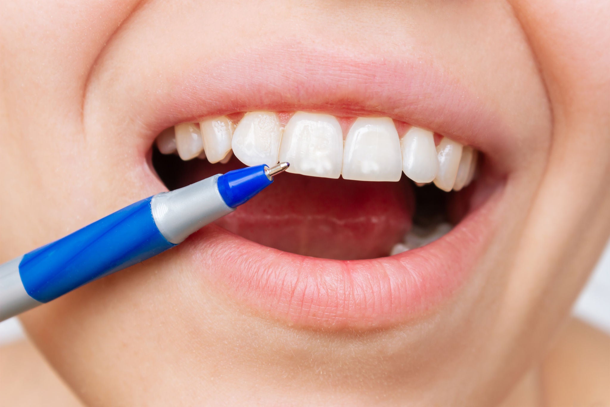 Cropped shot of a young caucasian woman pointing to white spots on the tooth enamel with a pen. Oral hygiene, dental health care. Dentistry, demineralization of teeth, enamel hypoplasia, fluorosis, Cropped shot of a young caucasian woman pointing to white spots 