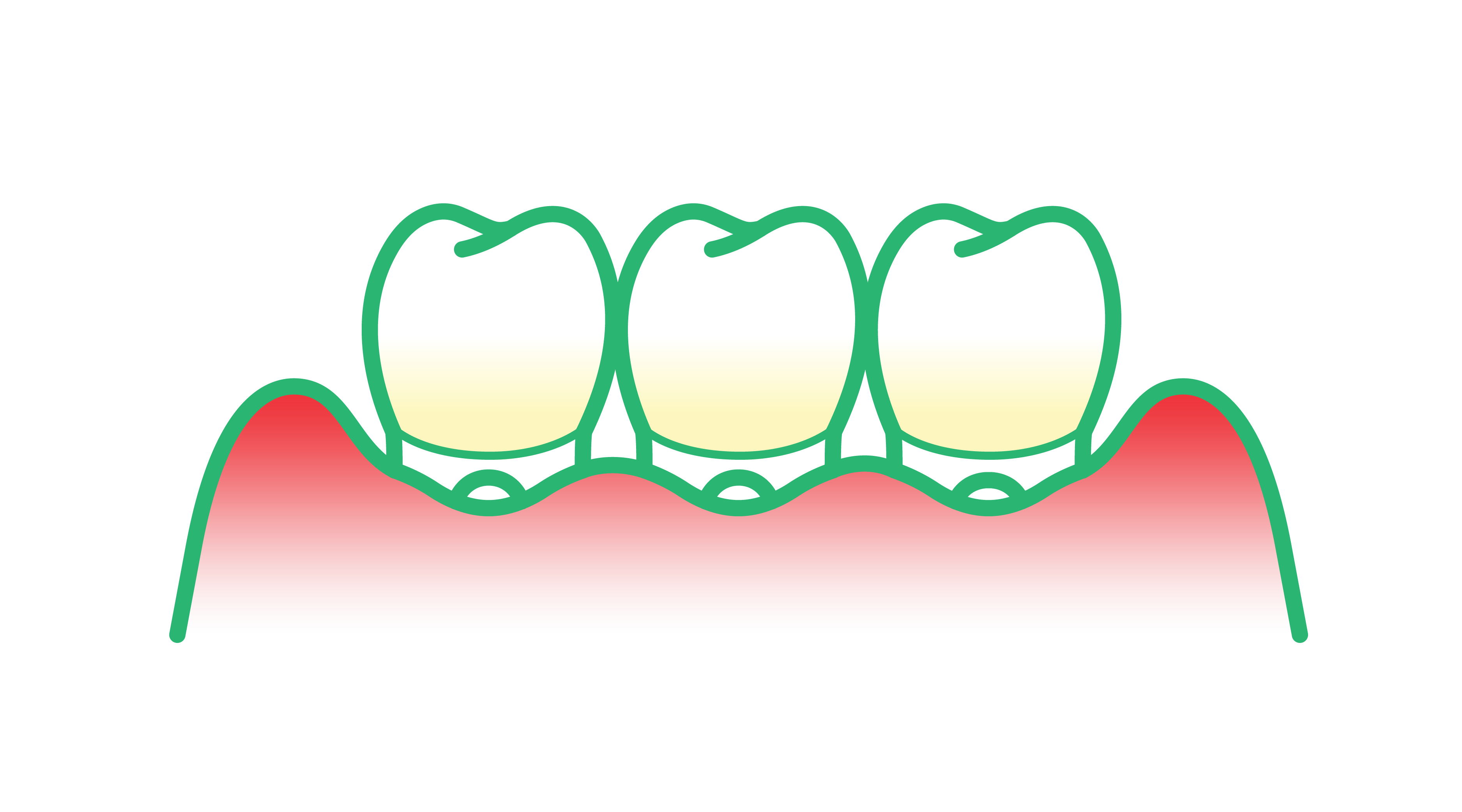 Periodontitis