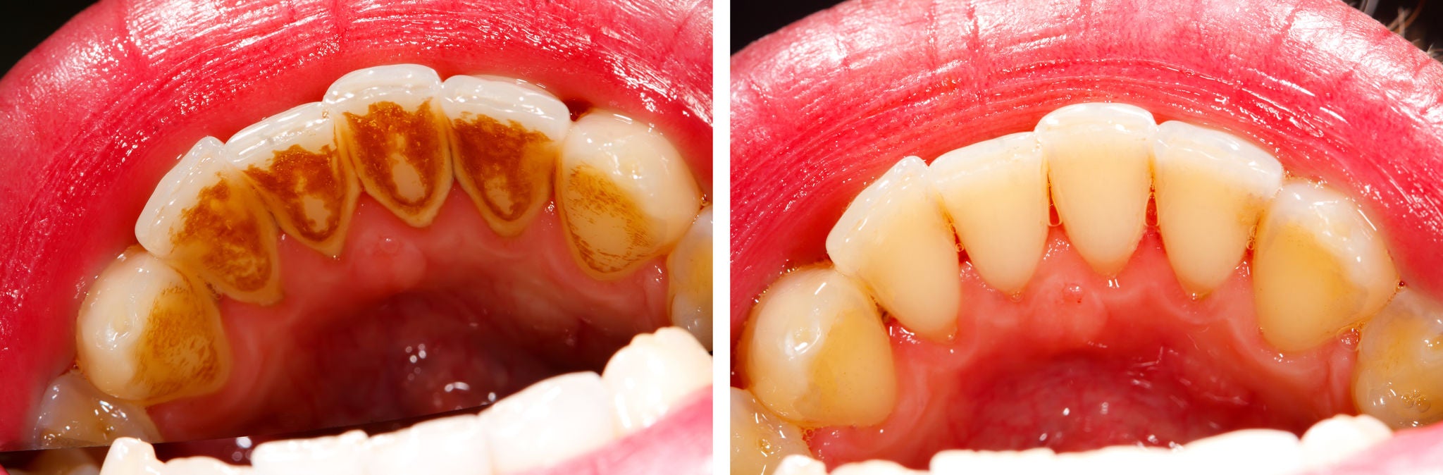Two photos made by dentist, one before and one after the treatment of dental tartar - the subsidence is the result of residual food, smoking and coffe drinking - part of Beforeafter series.