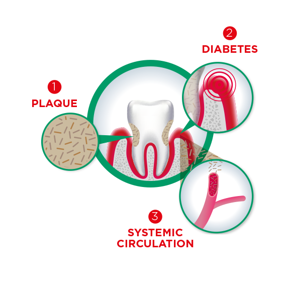 Infographic about the link between diabetes and periodontal desease