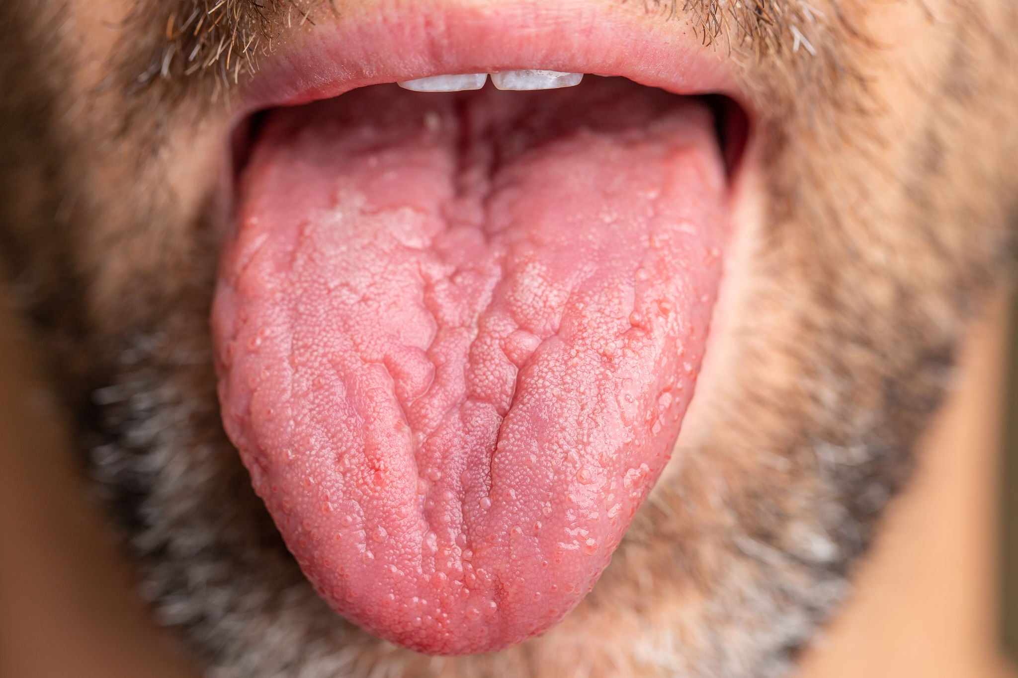 A white male with brown and white facial hair. Tongue is sticking out to show geographic tongue, also known as benign migratory glossitis where lines form and can cause pain or discomfort., A white male with brown and white facial hair. Tongue is stickin