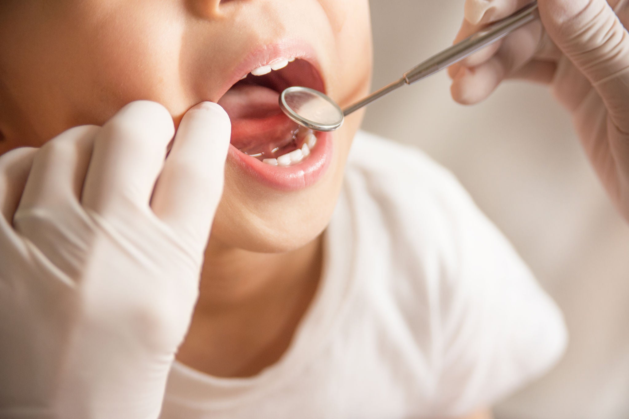 MIH o ipomineralizzazione dei denti nei bambini: trattamento e raccomandazioni