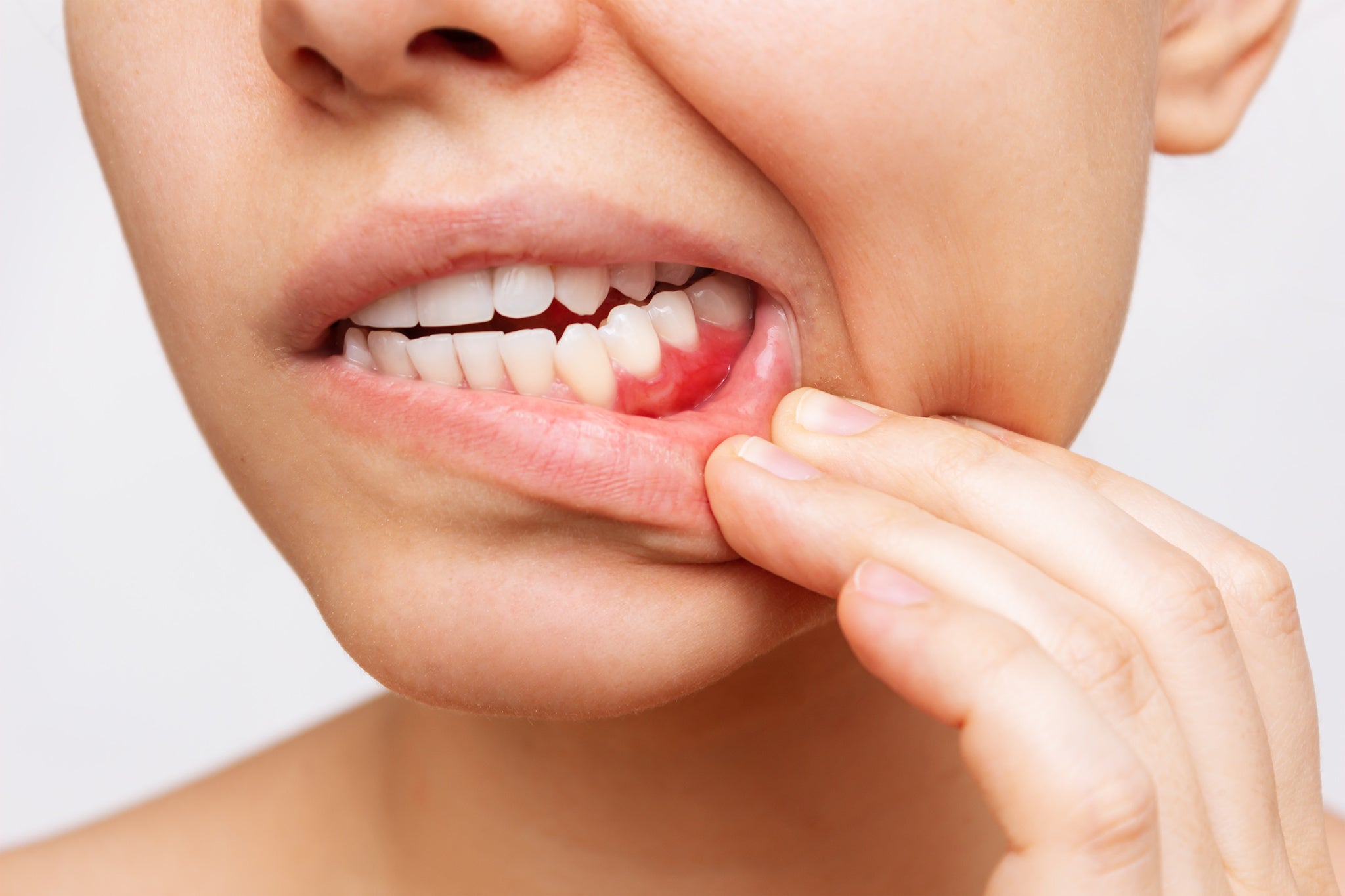 Aidez vos patients à prévenir la gingivite et la parodontite