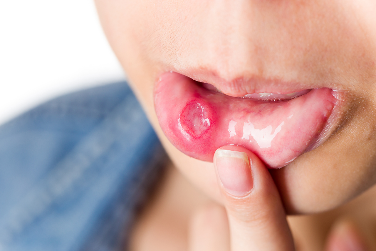 Woman with mouth ulcer aphtha