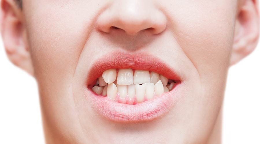 Der Zusammenhang von Zahnfehlstellung und Parodontitis