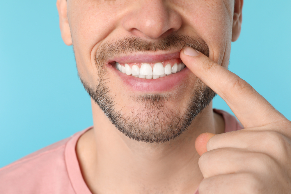 Amelogenesi imperfetta: come curare e prevenire le anomalie dello smalto dentale