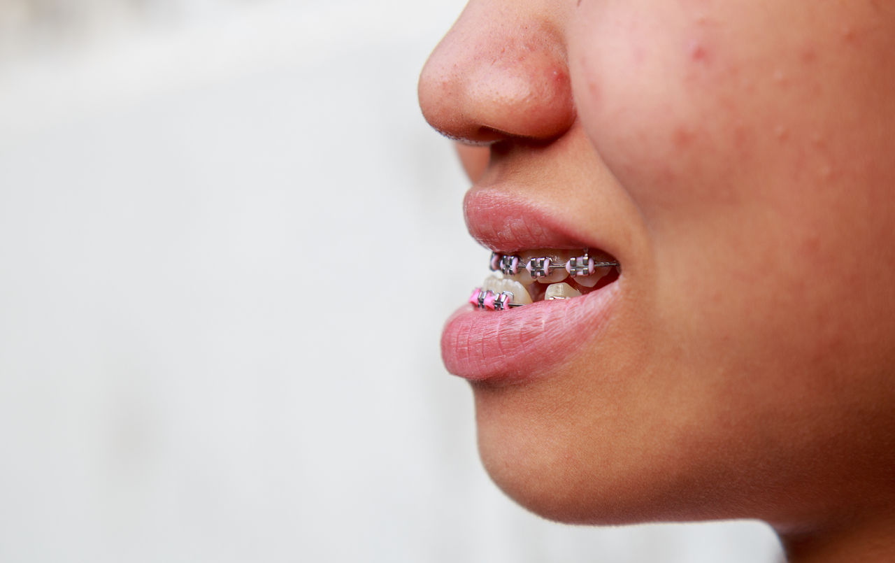 Teen Asian Ethnicity Problems with teeth can be treated with braces to treat symptoms prognathism make mouth awry.