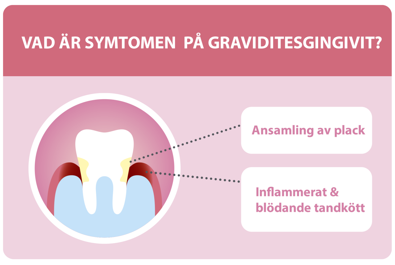 Tand illustrerad med tandplack och graviditetsgingivit